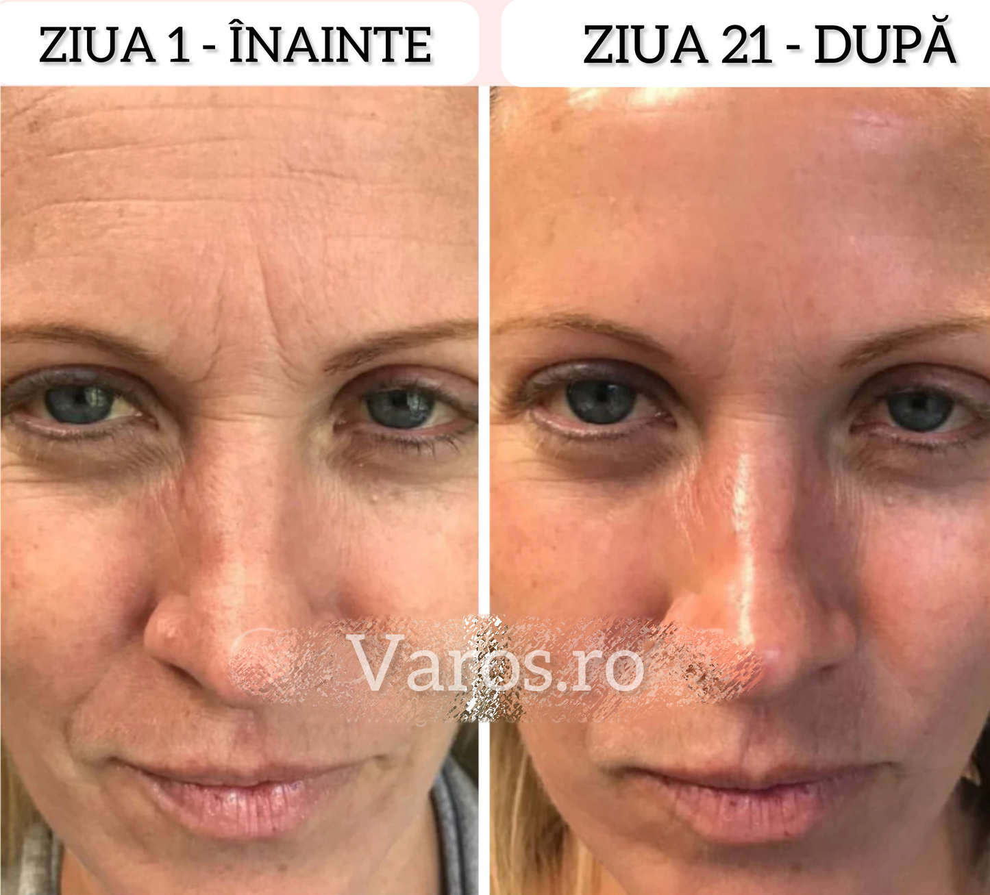 Dispozitiv facial pentru eliminarea ridurilor