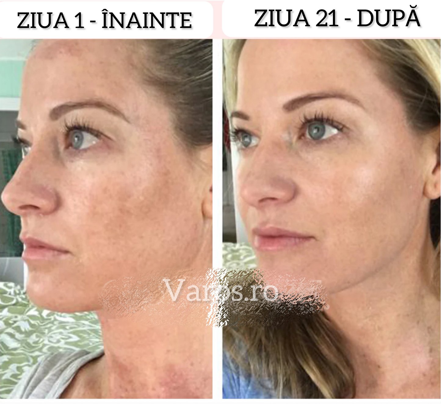 Dispozitiv facial pentru eliminarea ridurilor