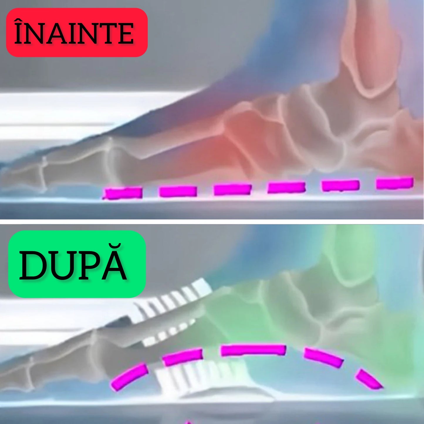 SET 2 X Suport pentru Fasceită Plantară