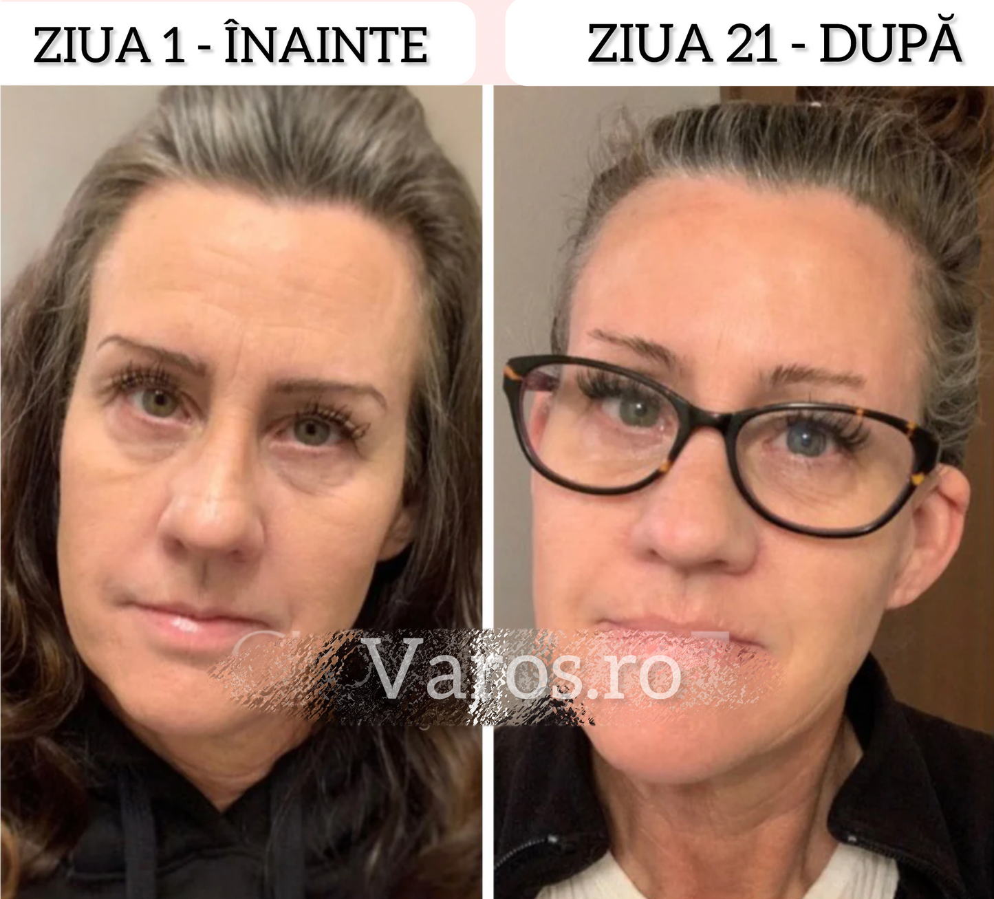 Dispozitiv facial pentru eliminarea ridurilor